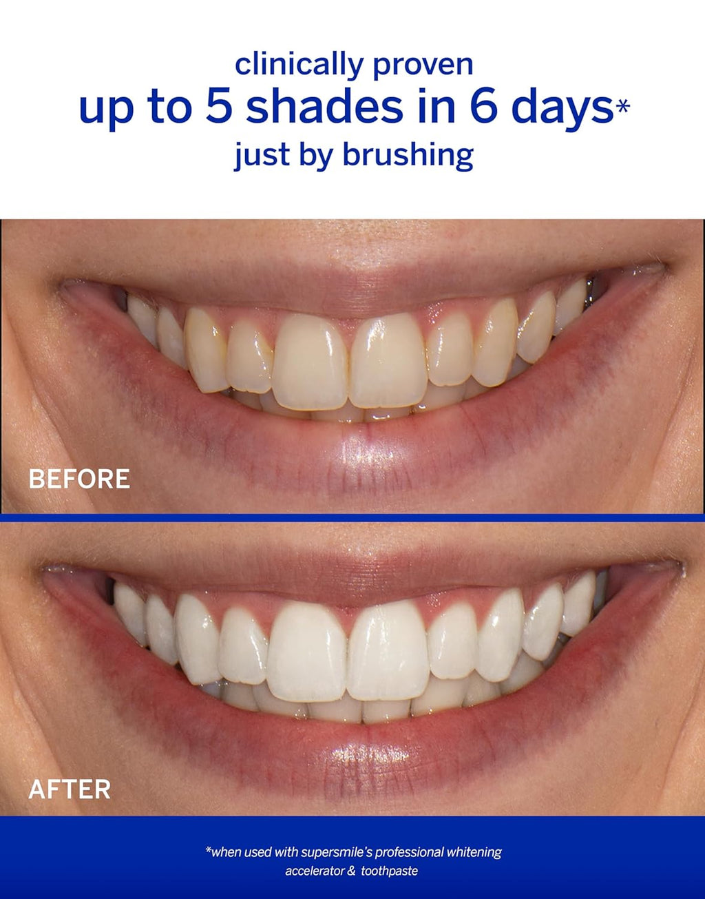 Supersmile Professional Whitening Toothpaste – Fluoride Toothpaste for Visibly Whiter Teeth – Whitens up to 6 Shades