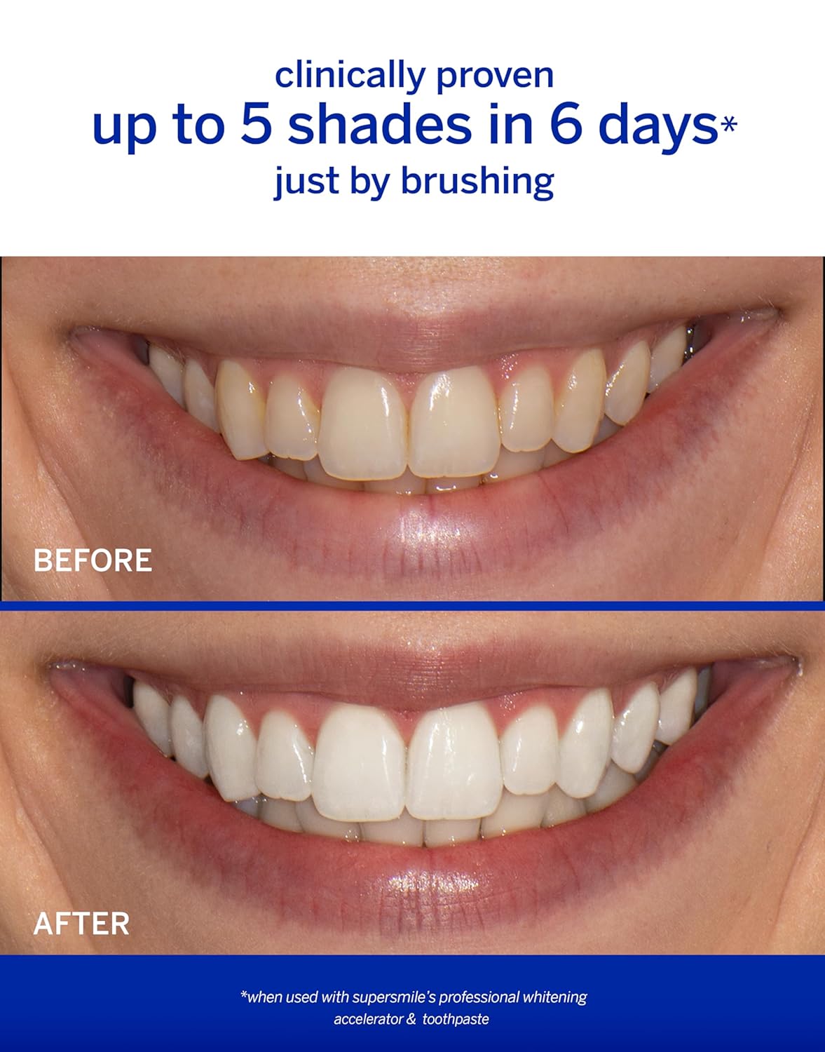 Supersmile Professional Whitening Toothpaste – Fluoride Toothpaste for Visibly Whiter Teeth – Whitens up to 6 Shades